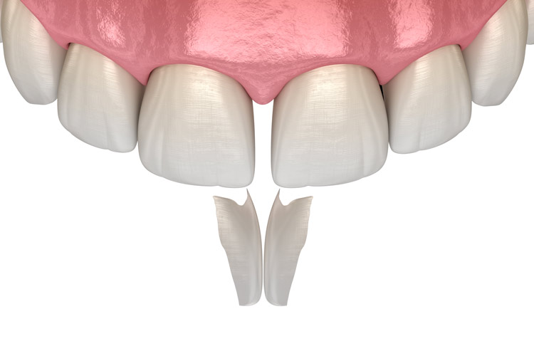 dental-bonding-in-bangalore