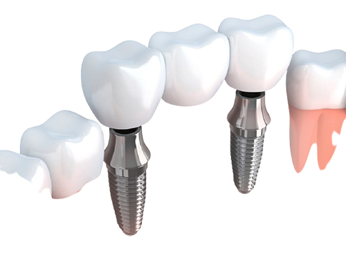 dental-bridges-in-bangalore