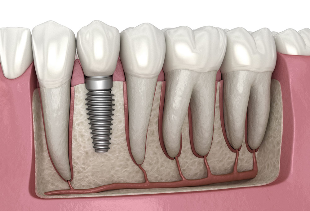 dental-implants-in-bangalore