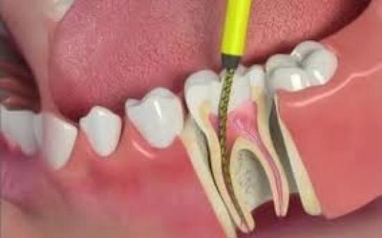 root-canal-treatment-in-bangalore