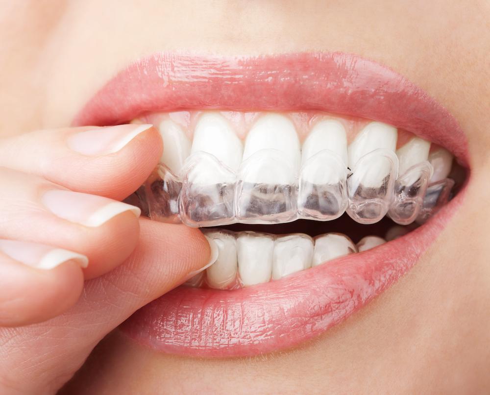 teeth-aligners-in-bangalore