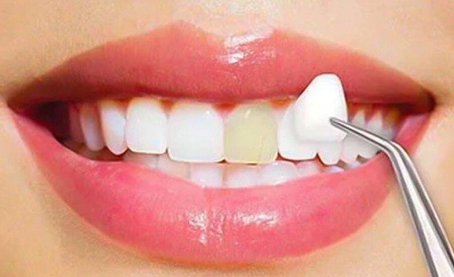 veeners-cosmetic-dentistry-procedures